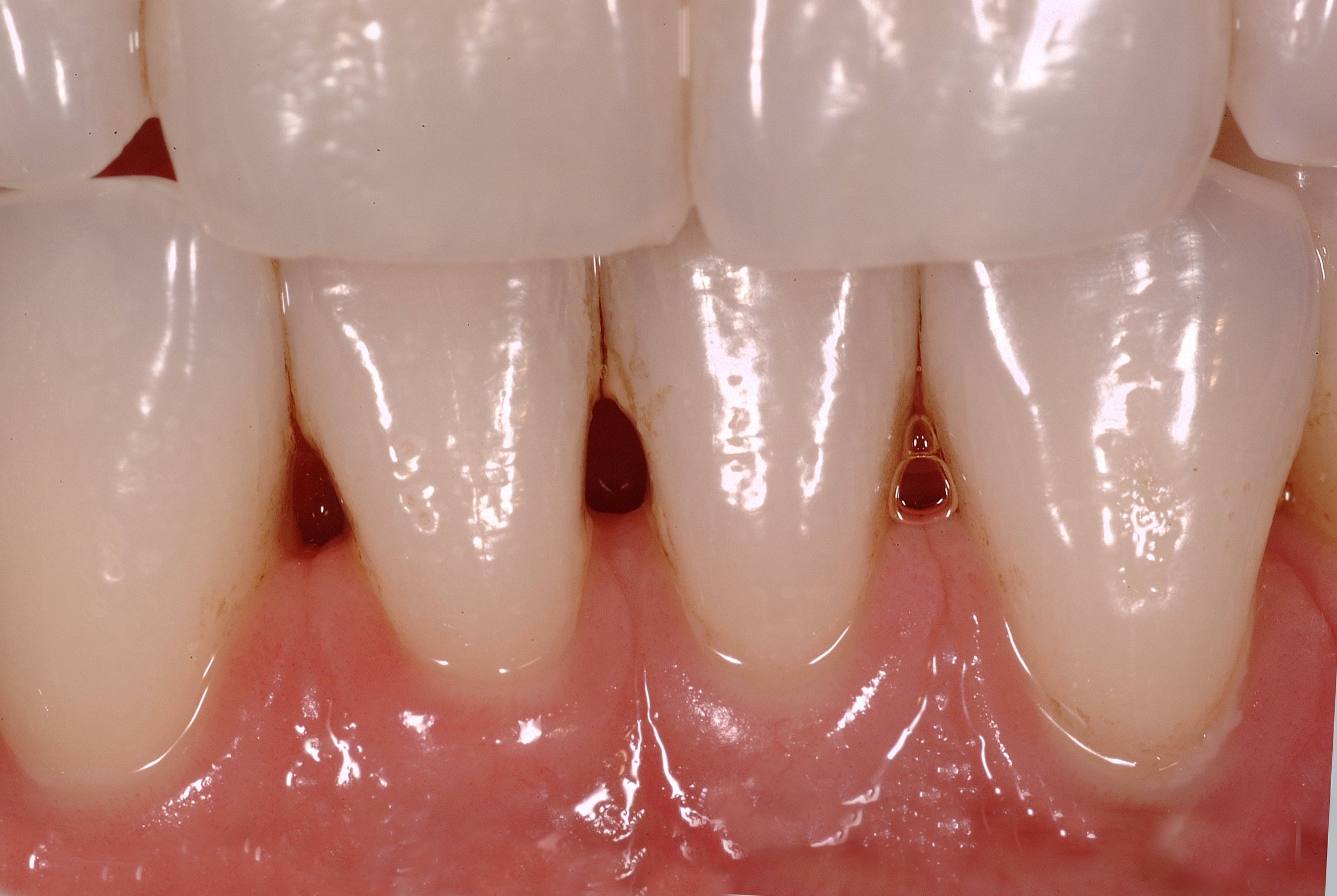 Closing the Gap in Direct Dentistry Treating Black Triangles Optident